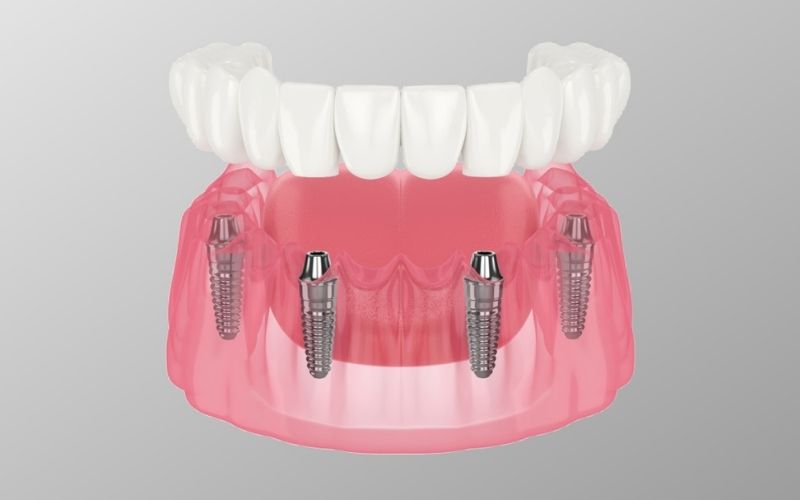 All-on-X permanent denture cape coral, fl