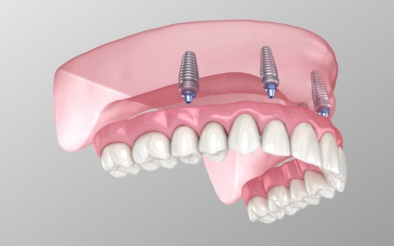 Snap-in denture cape coral, fl