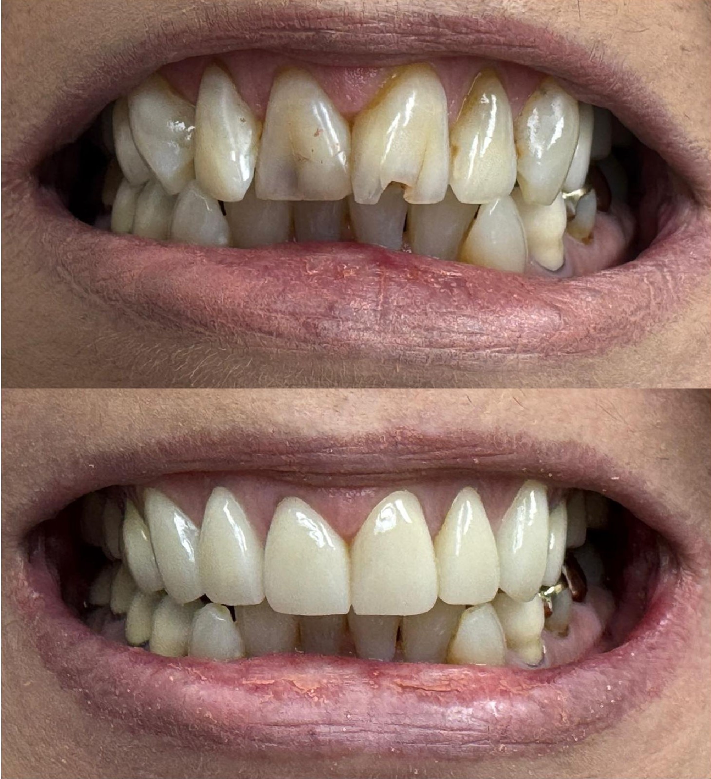 Anterior Crowns Before and After