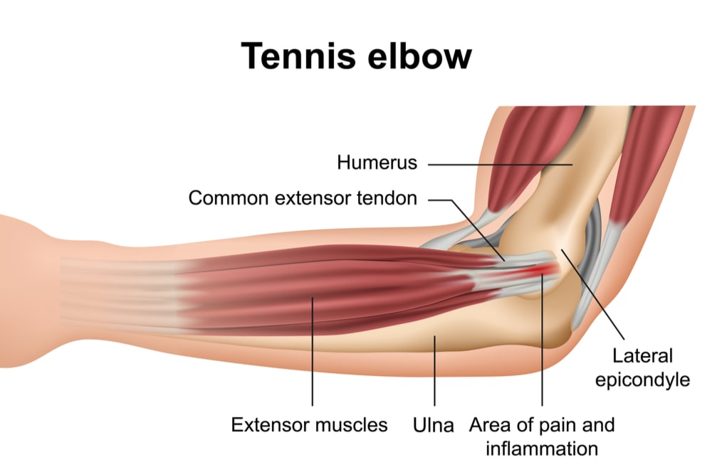 Tennis elbow injury