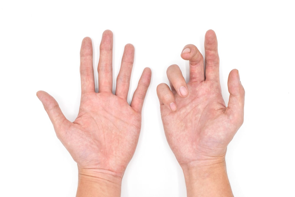 Dupuytren’s contracture in right hand