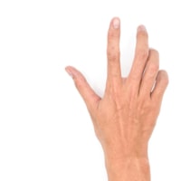 Dupuytren’s Contracture