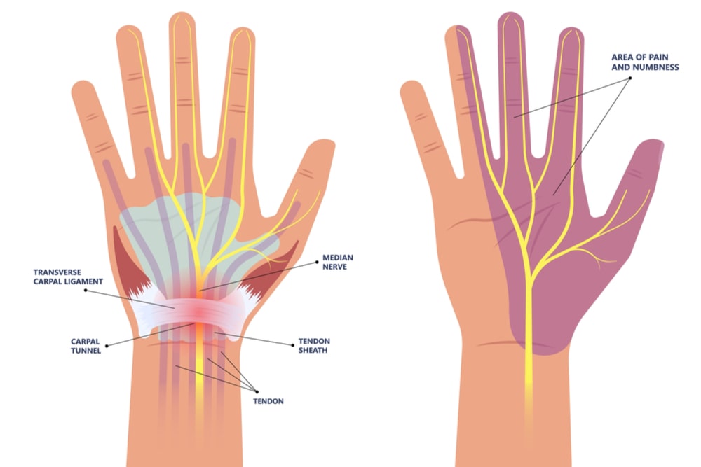 Carpal Tunnel Syndrome pain hand arm wrist splint