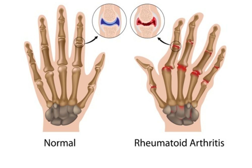Rheumatoid arthritis of finger joint