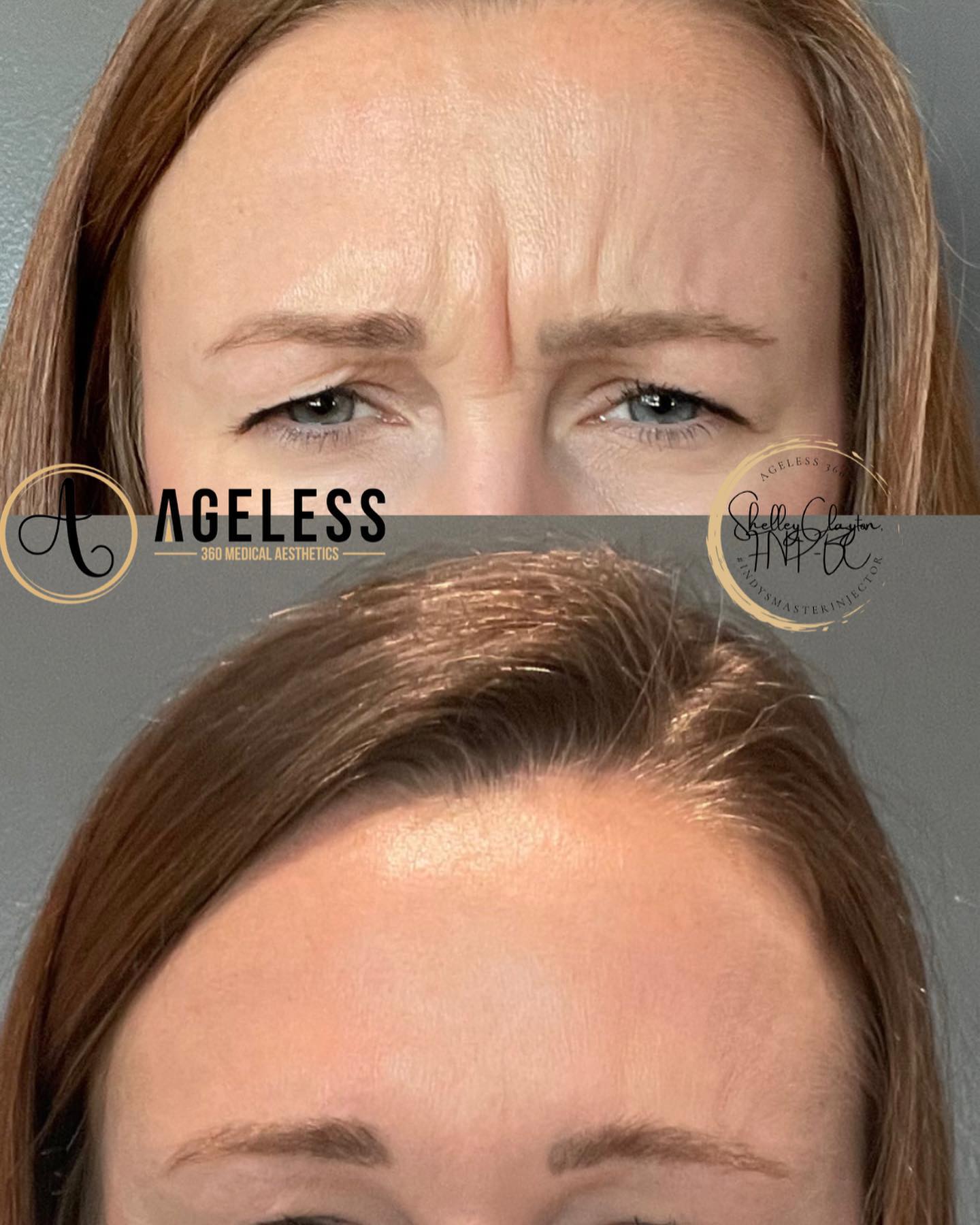 botox before and after