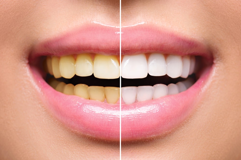 Woman Teeth Before and After Whitening