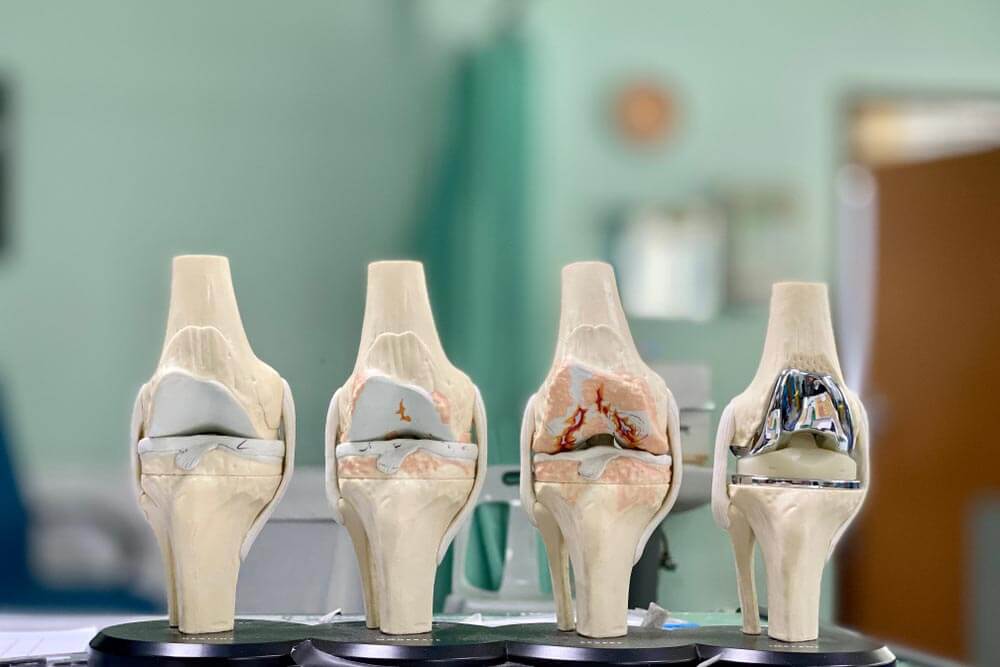 Anatomical model of knee