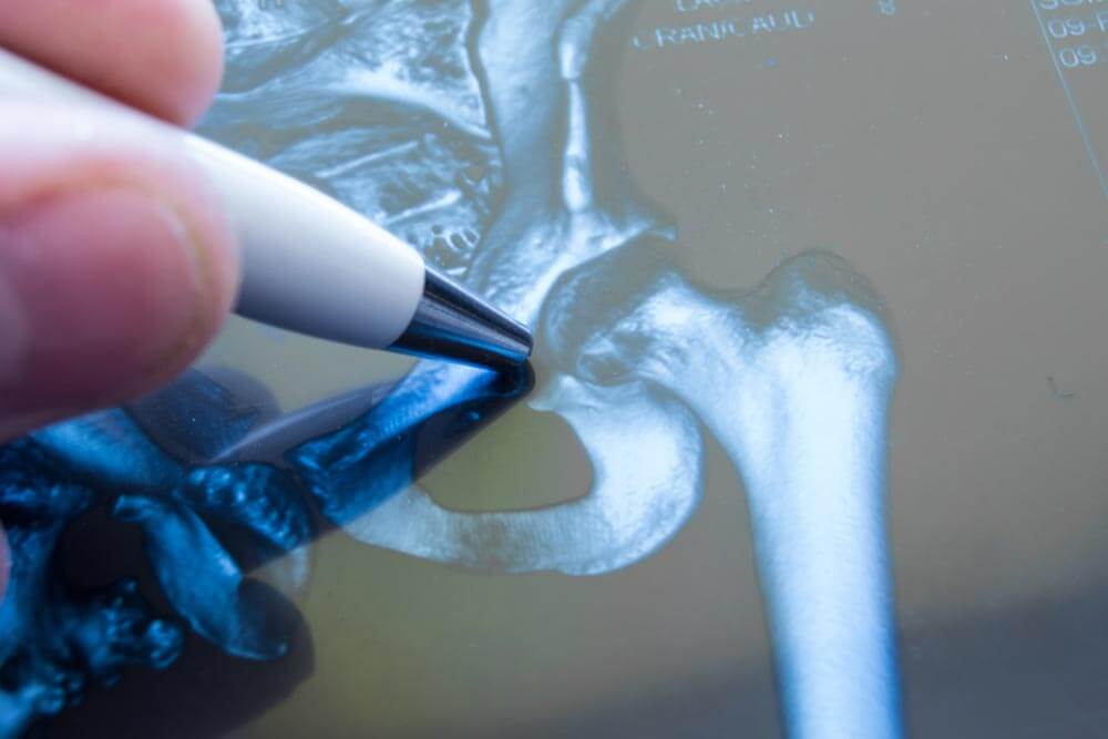 X-ray of hip joint