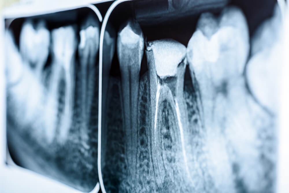 dental x-ray of a root canal issue