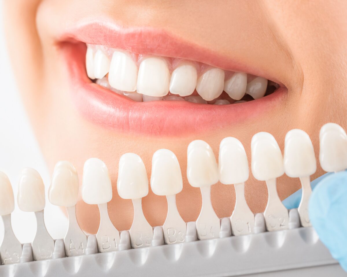 Teeth Whitening Estero, FL