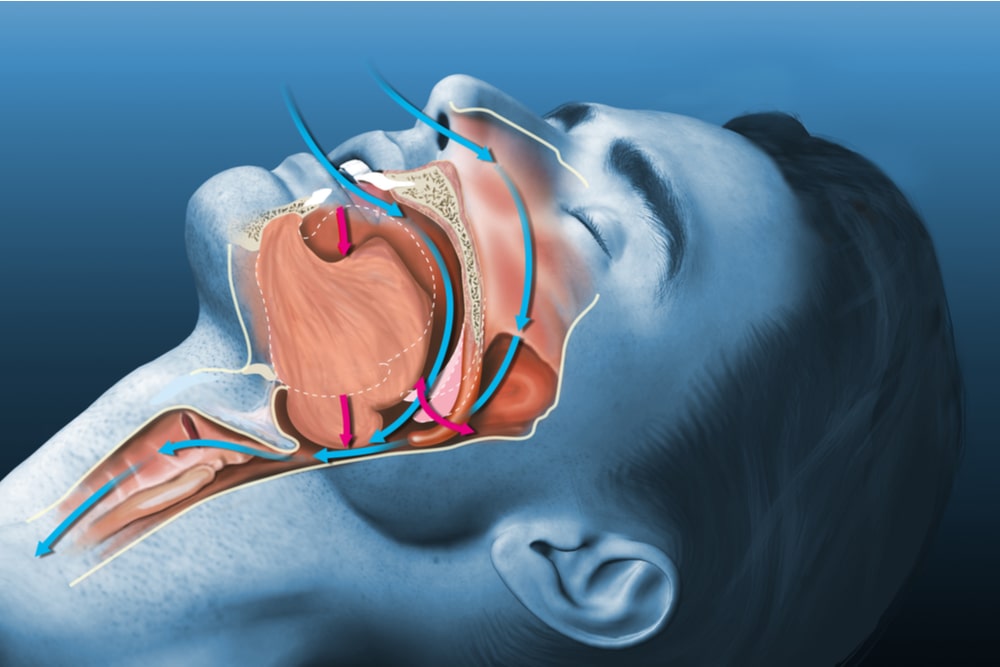 Medically 3D illustration shows a sleeping snoring man