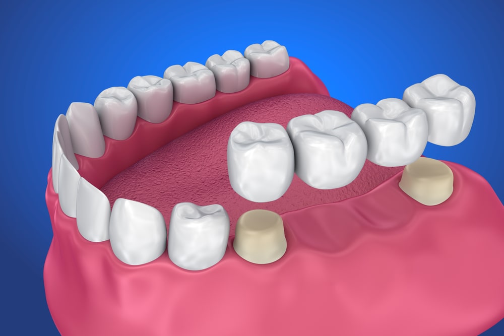 Tooth supported fixed bridge, 3D illustration