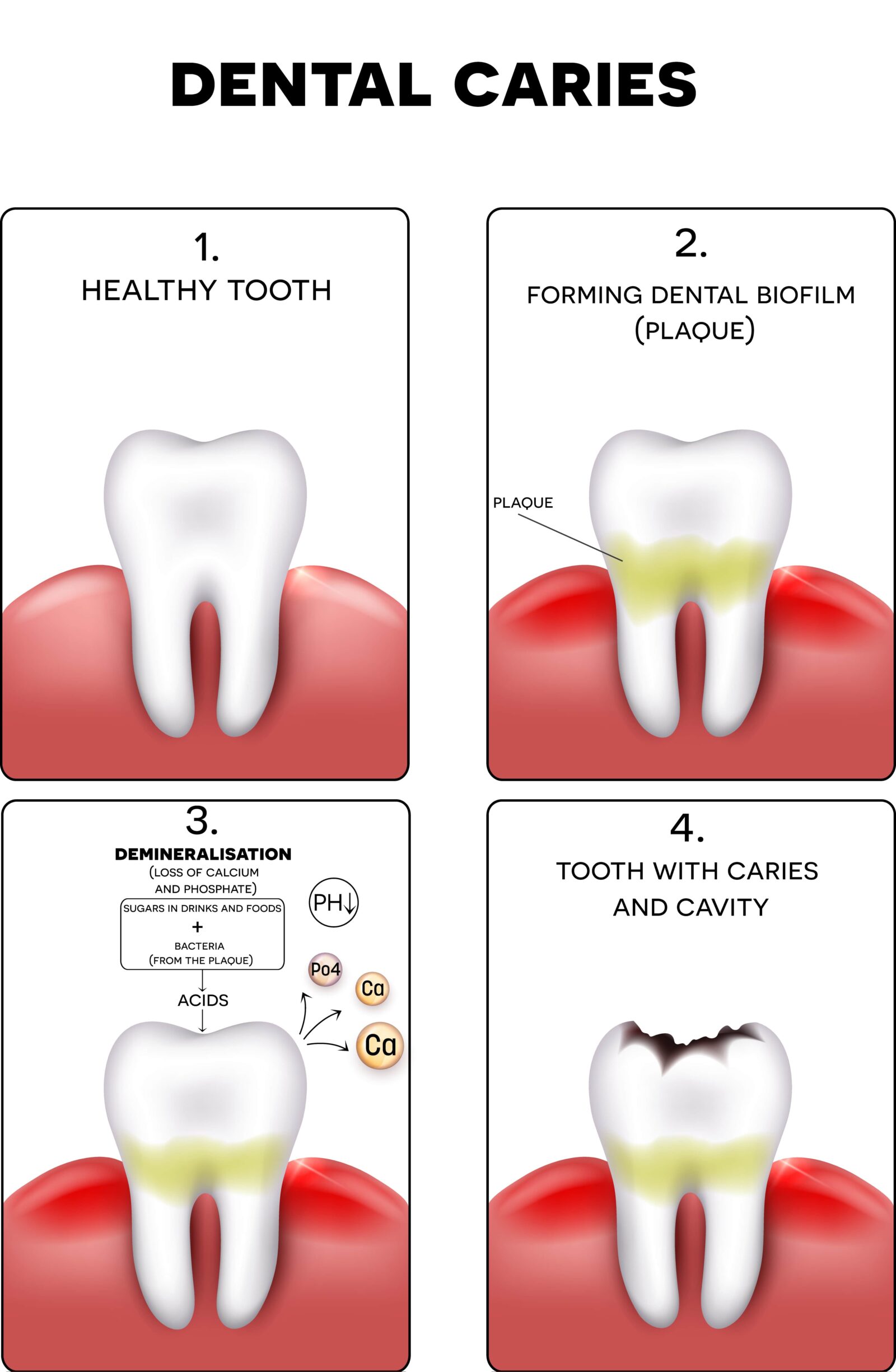 Cavities In Teeth