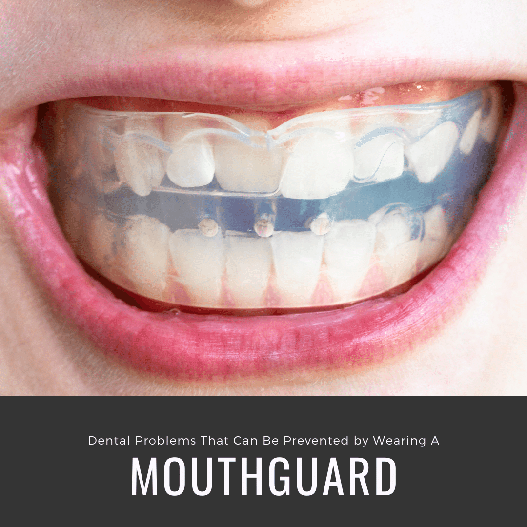 Dental Problems That Can Be prevented by wearing a mouthguard