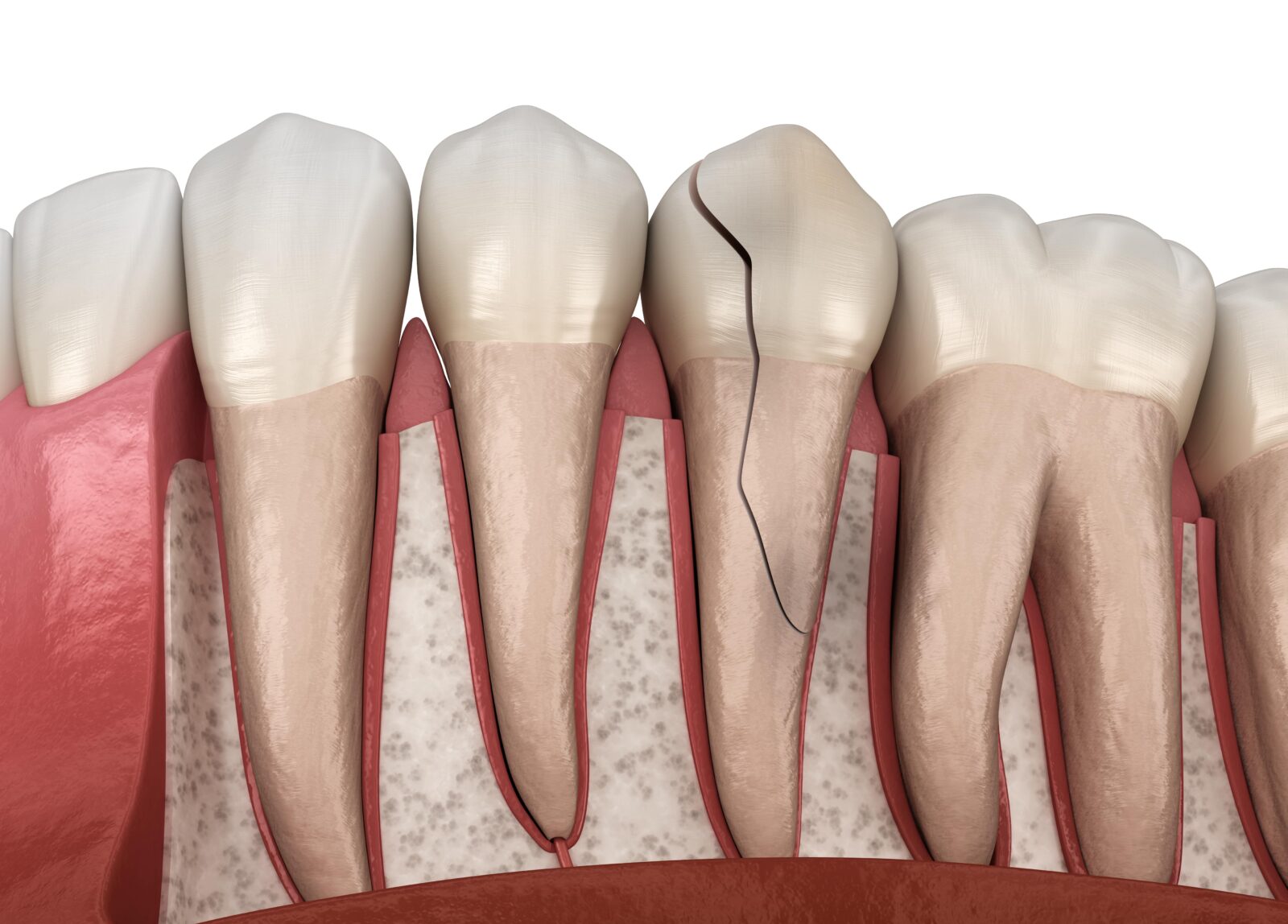 tooth with fracture from crown to root