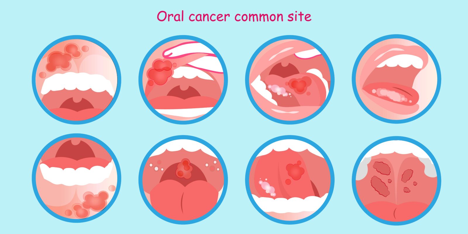 common sites of oral cancer