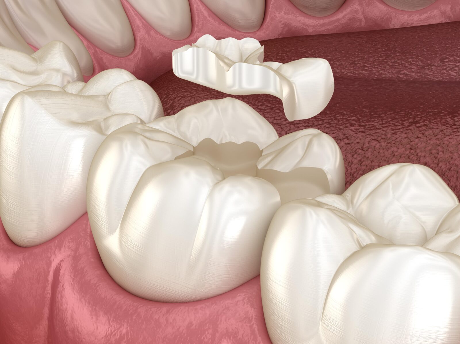 dental inlay