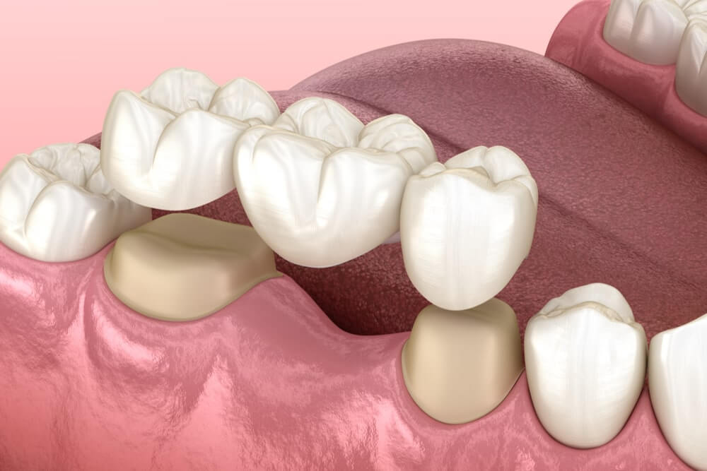 Dental bridge of 3 teeth over molar and premolar
