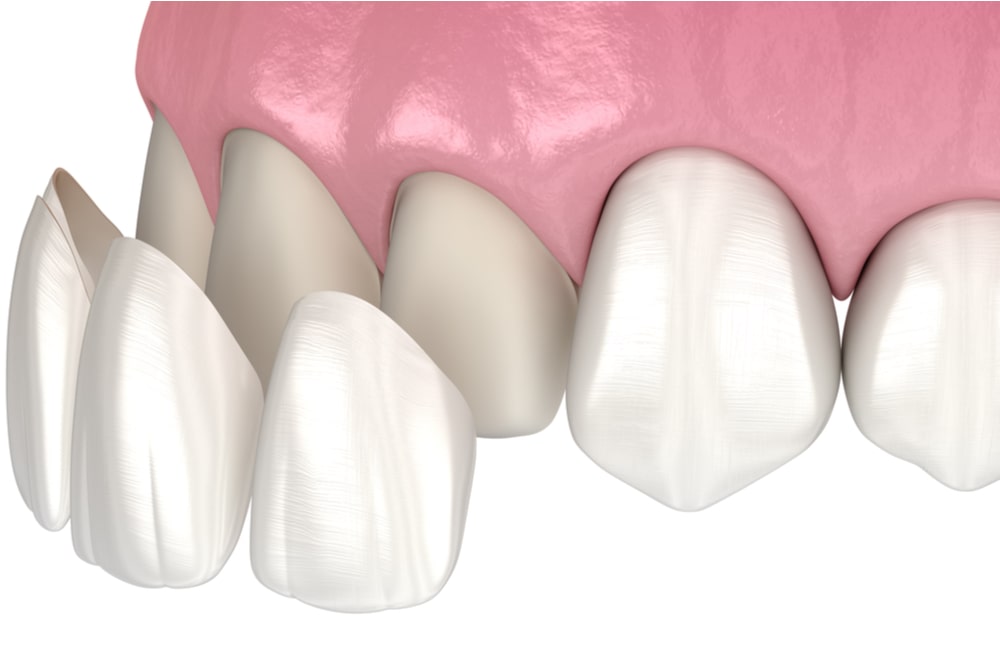 Veneer installation procedure over central incisor