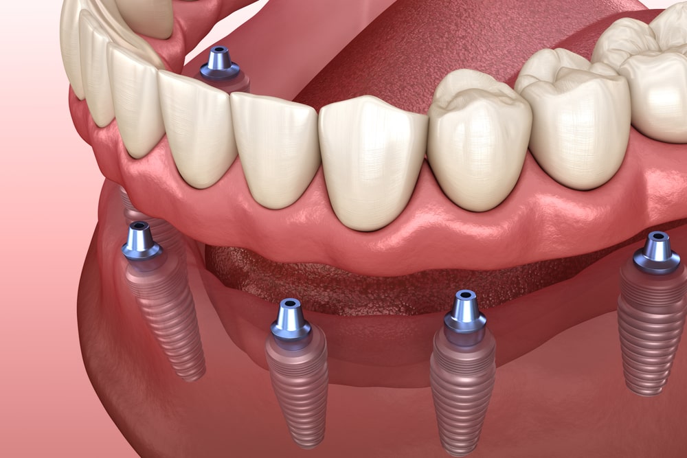 Mandibular prosthesis with gum All on 6 system