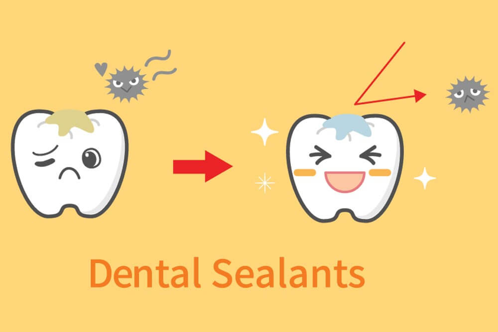 illustrations of dental sealants treatment before after