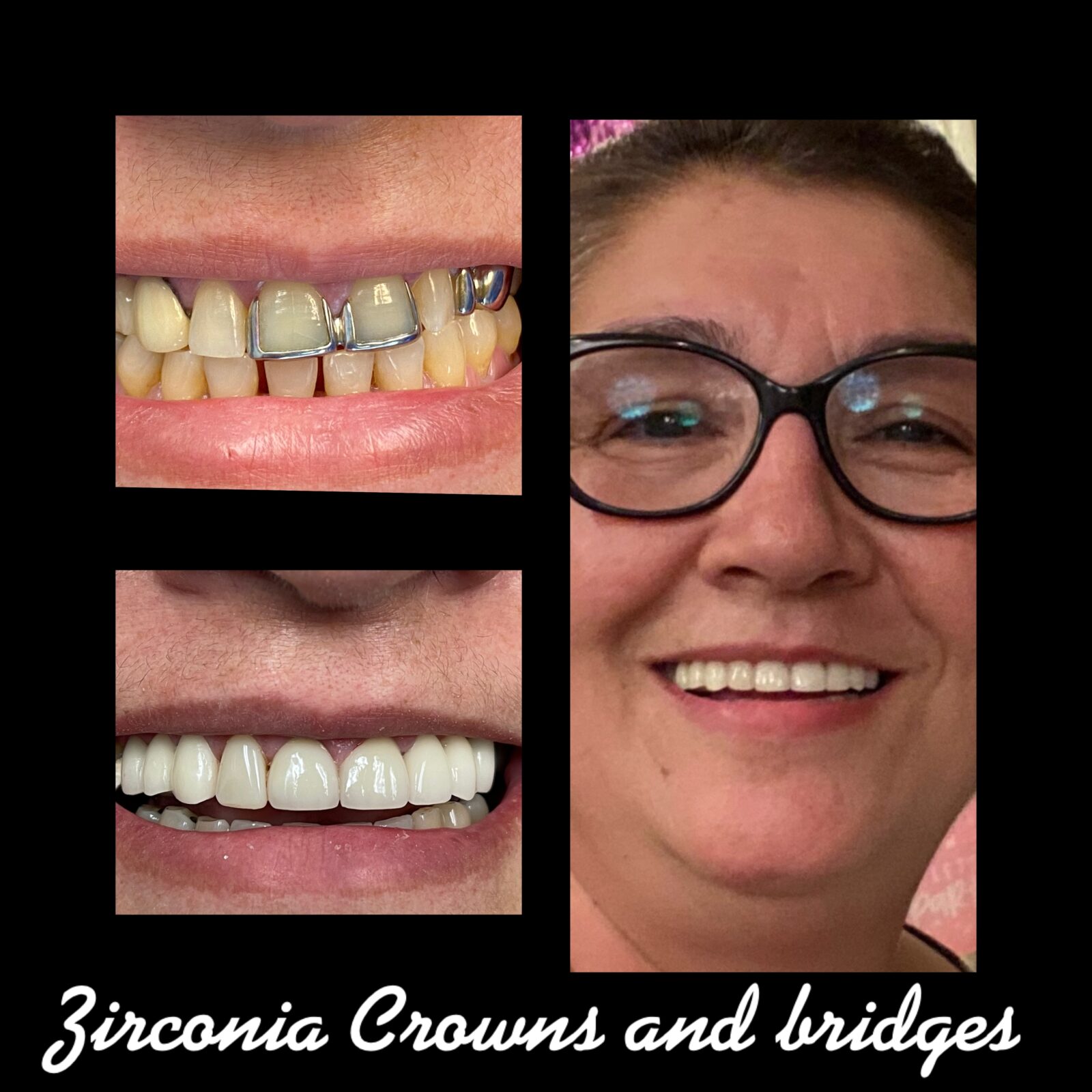 Zirconia Crown & Bridges