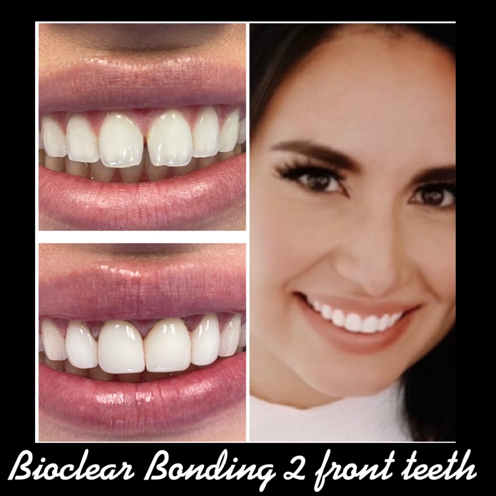 Bioclear Bonding To 2 upper front teeth
