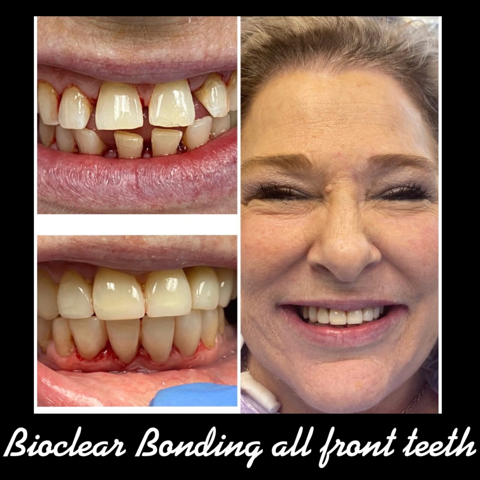 Bioclear Bonding to restore multiple spacing of teeth