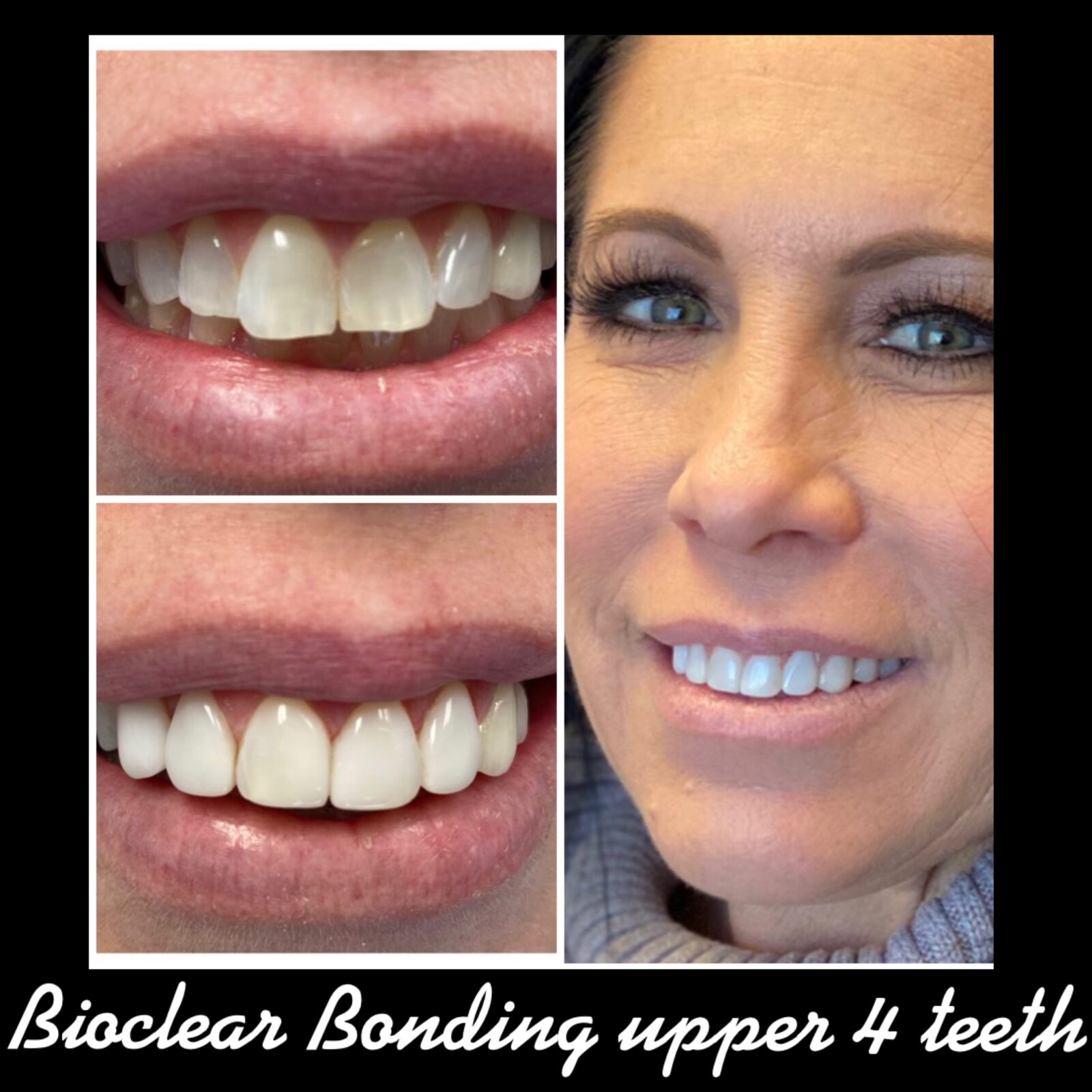 Bioclear Bonding to correct malaligned teeth