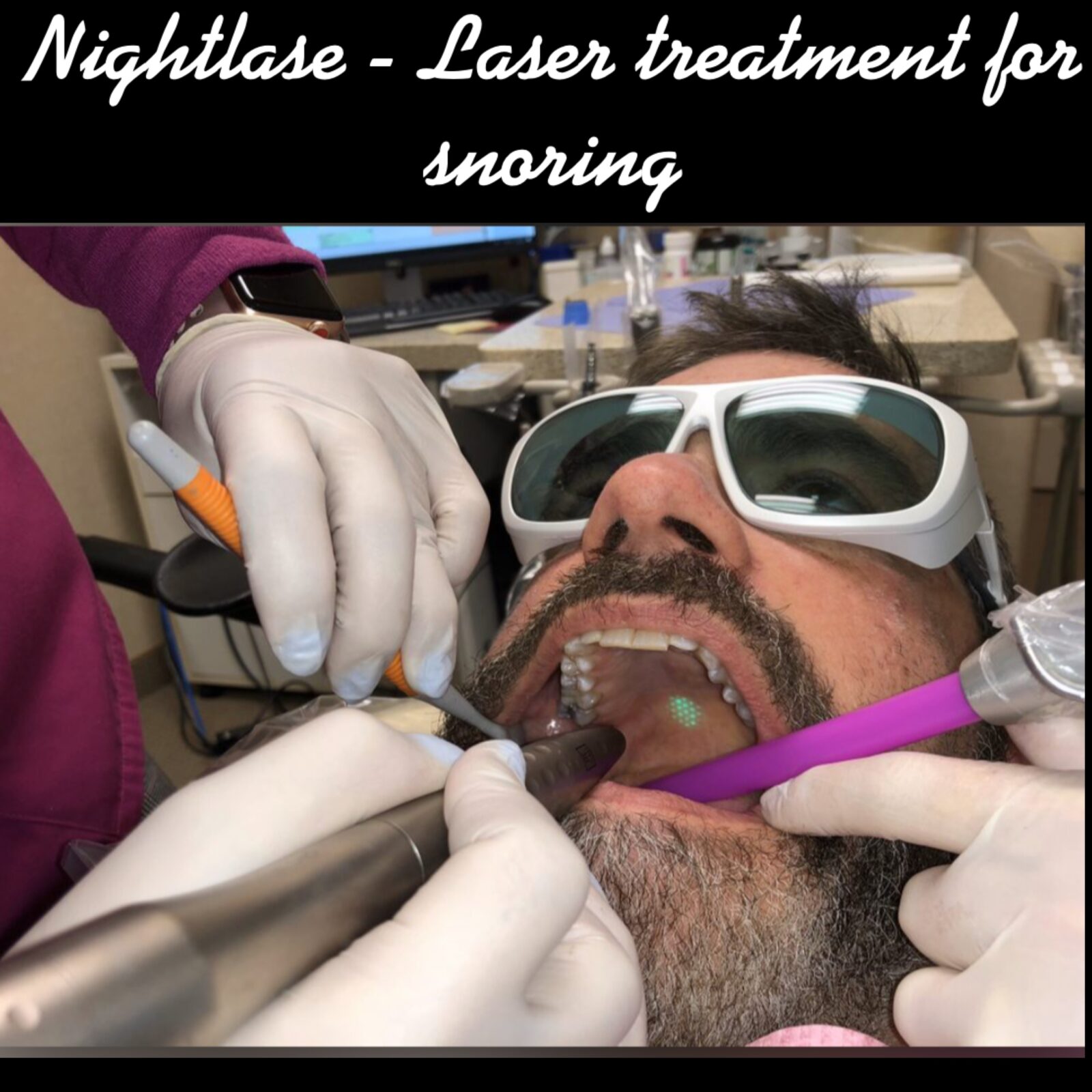 Nightlase – Laser treatment for snoring