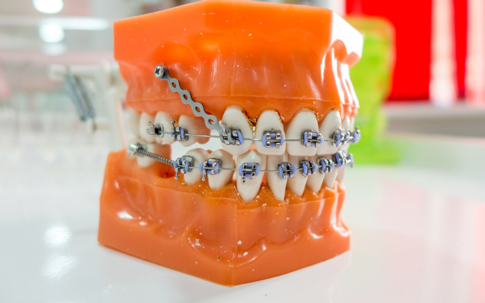 Orthodontic Anchorage Model