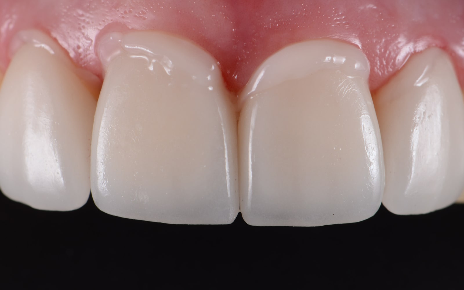 Dental Bonding Restoration