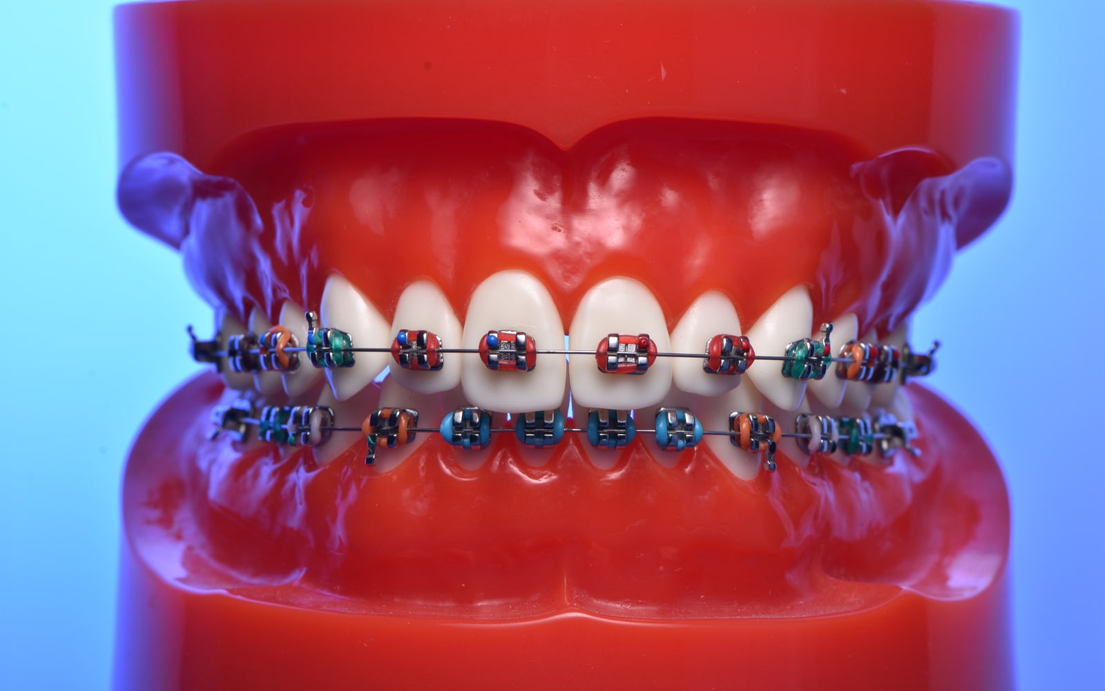 Model of Braces Up Close