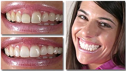 Before After Porcelain Crown Gum Recontouring