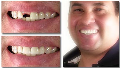 Before After Single Dental Implant