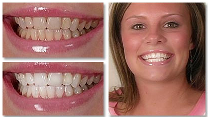 Before After Take Home Whitening