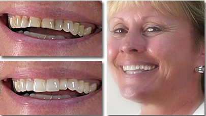 Before and After Whitening and Porcelain Veneers