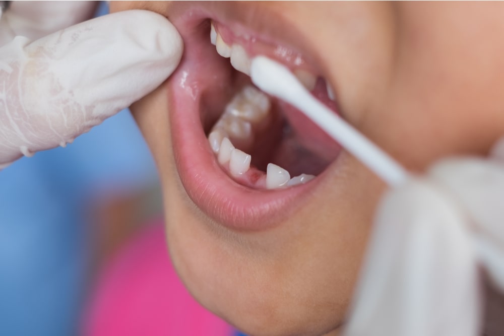 Children boy receive fluoride medicine and dental examination