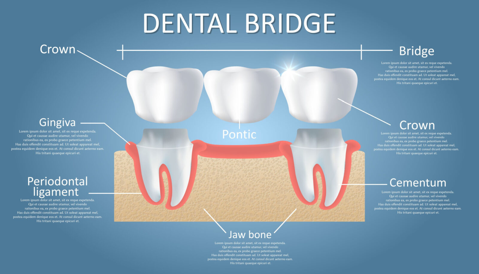  A diagram of what Dental Bridges look like