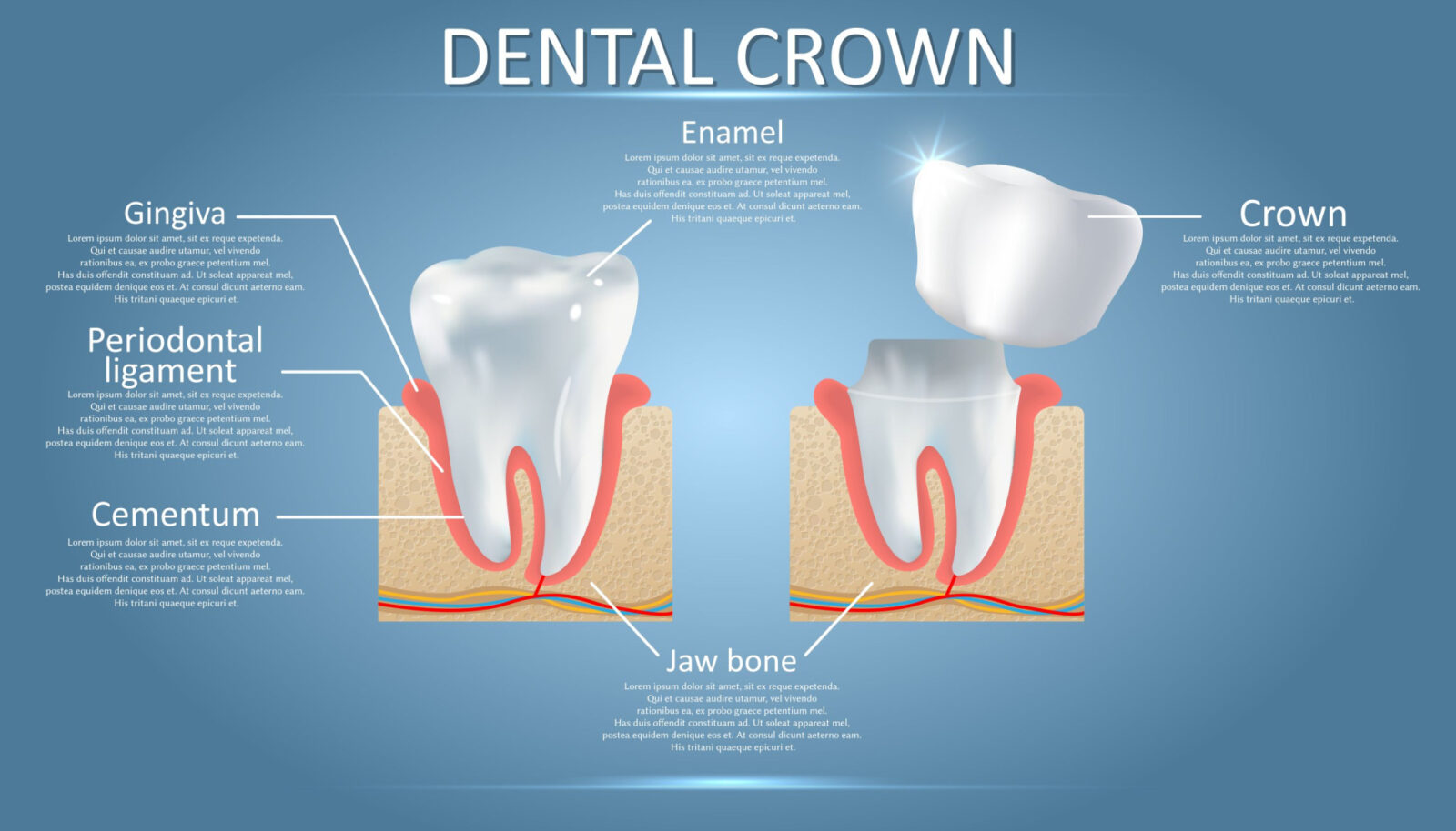 A diagram of what Dental Crowns look like