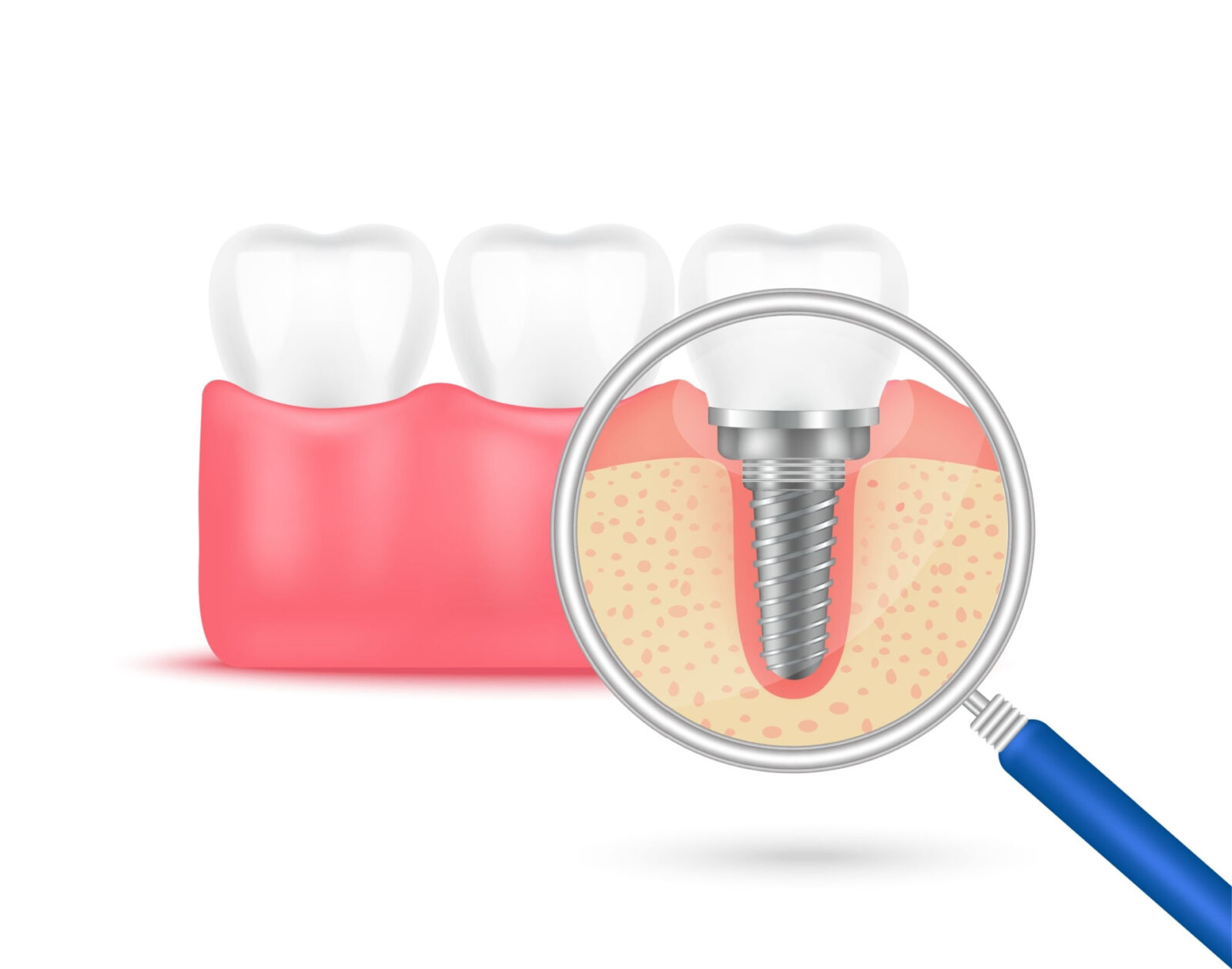 An illustration of Restorative Implants