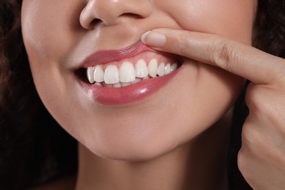 A woman checking her gums after receiving PRP Treatment for Tissue Grafting