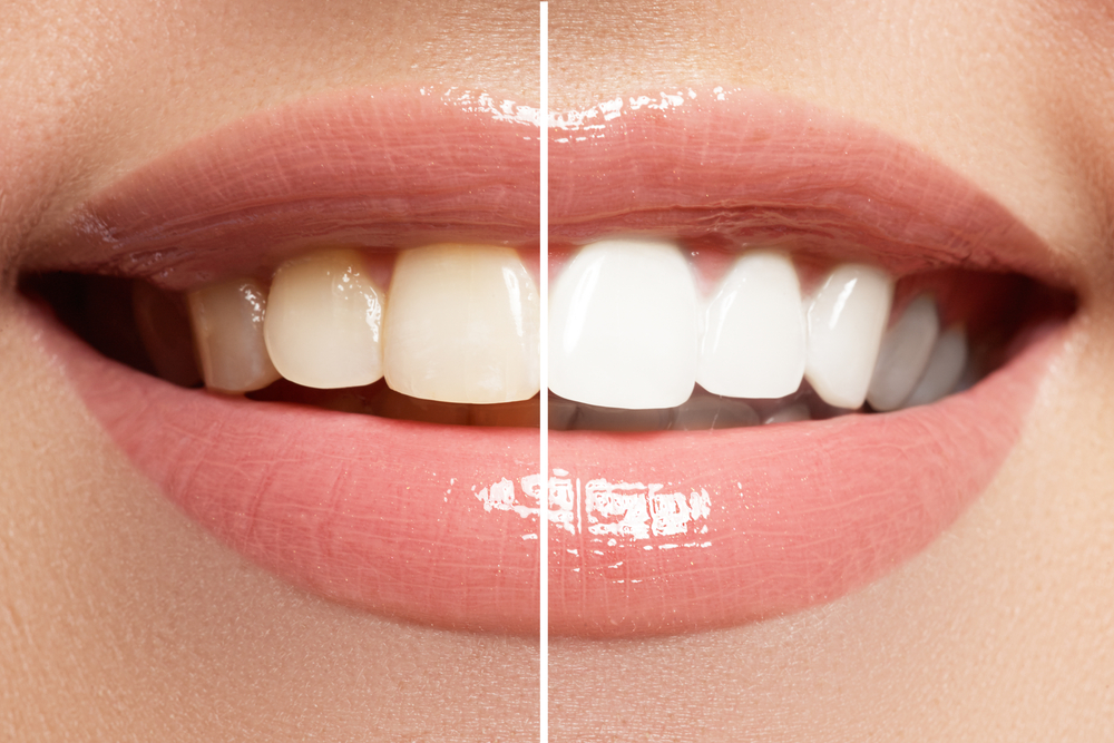 A before and after of teeth whitening on someone's teeth