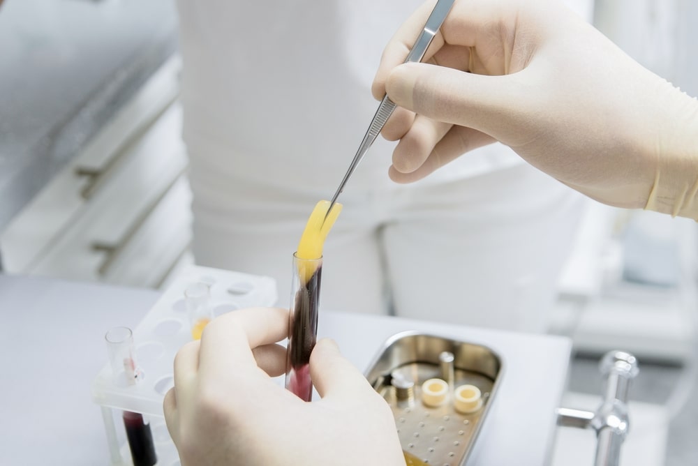 platelet-enriched plasma. Obtaining plasma in dentistry