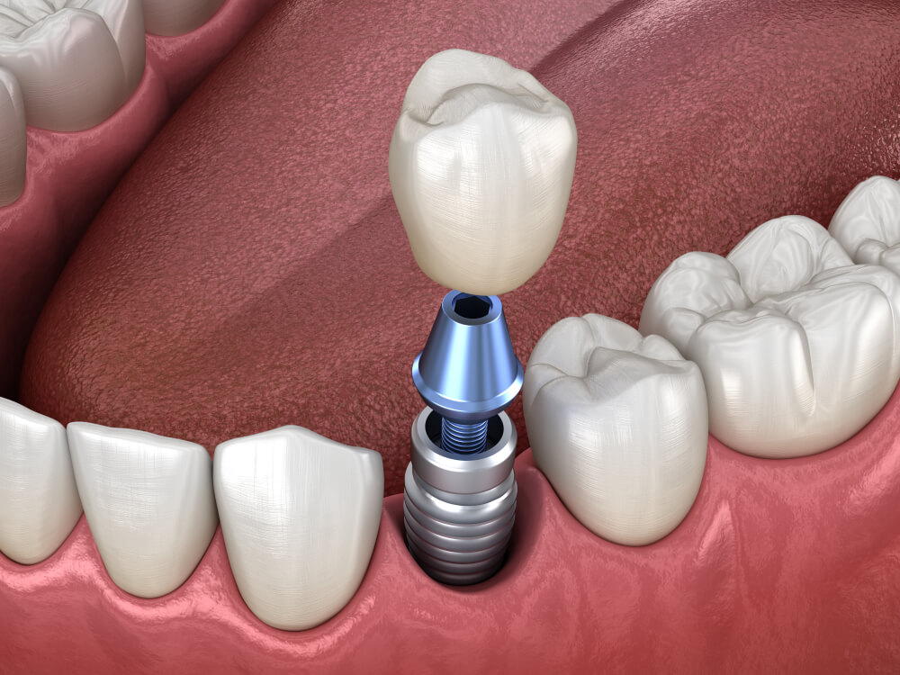 Premolar tooth crown installation over implant abutment
