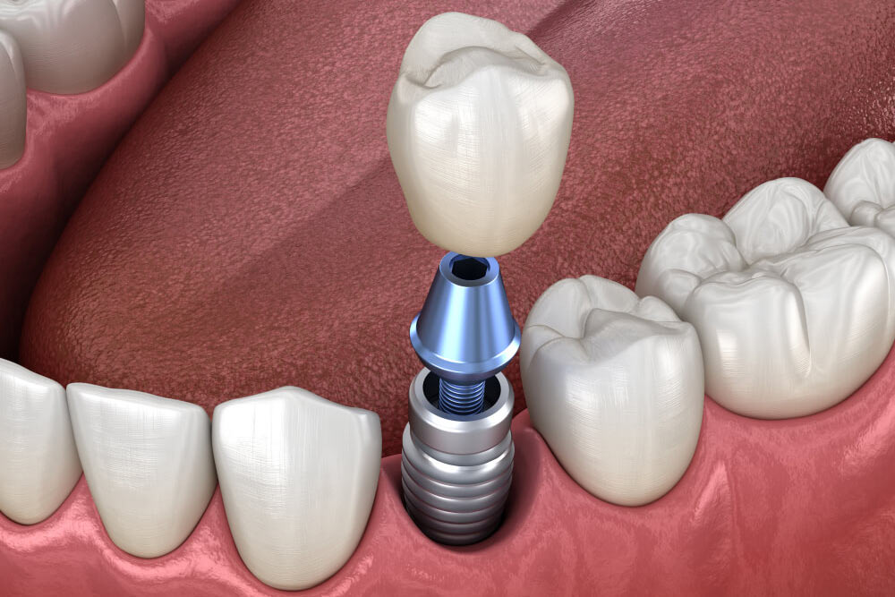 Premolar tooth crown installation over implant abutment
