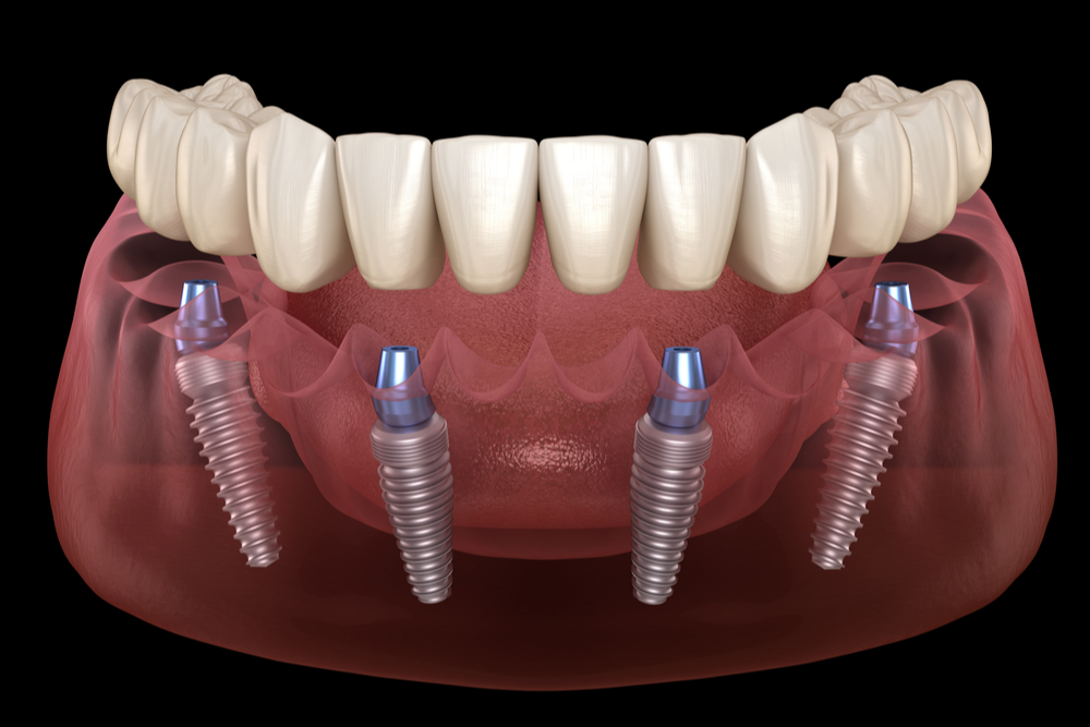 Mandibular prosthesis All on 4 system