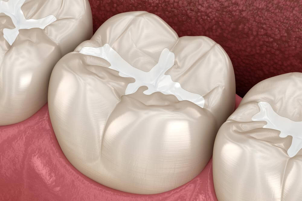 Molar Fissure dental fillings