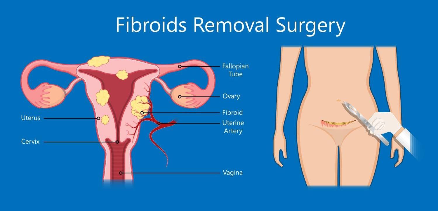 fibroids removal surgery