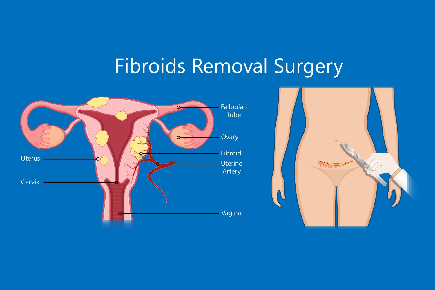 fibroids removal surgery